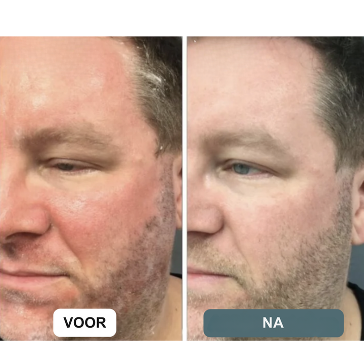 Calura™ | weg met jeuk, roodheid en schaamte.